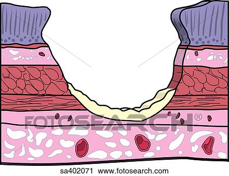 Layers of the lining of the stomach with ulcer, severity stage 3. View Large Illustration Clip Art - Layers of the lining of the stomach with ulcer, severity stage 3.. Fotosearch