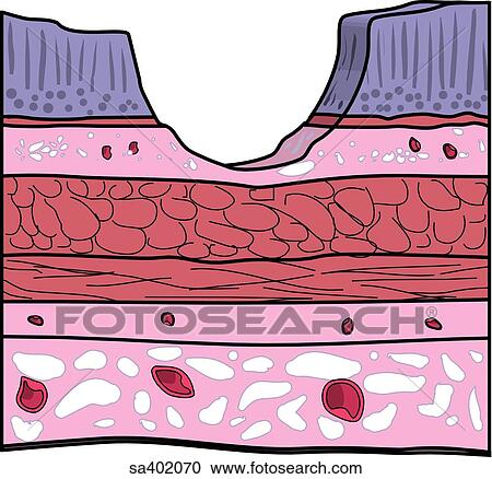 Clipart - Layers of the lining of the stomach with ulcer, severity stage 2.. Fotosearch