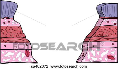 Layers of the lining of the stomach with ulcer, severity stage 4. View Large Illustration Drawing - Layers of the lining of the stomach with ulcer, severity stage 4.. Fotosearch