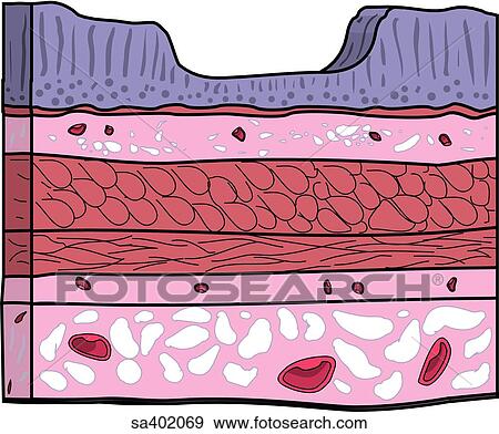 Stock Illustration - Layers of the lining of the stomach with ulcer, severity stage 1.. Fotosearch