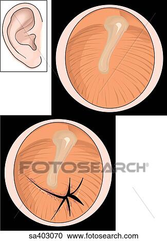 Orientation drawing of the ear. View Large Illustration Clipart - Orientation drawing of the ear.. Fotosearch
