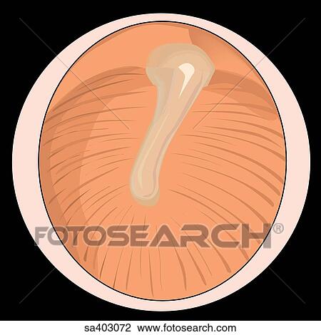 Ruptured tympanic membrane as viewed through an otoscope. View Large Illustration Drawing - Ruptured tympanic membrane as viewed through an otoscope.. Fotosearch