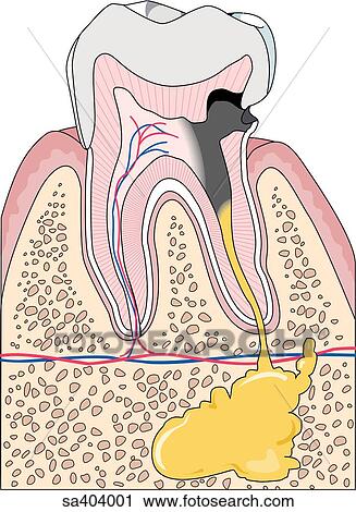 Sagittal cross-section of a caries damaged tooth and underlying abscess at root. View Large Illustration Clip Art - Sagittal cross-section of a caries damaged tooth and underlying abscess at root.. Fotosearch