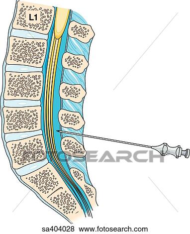 Stock Illustration - Sagittal section of lower spinal column with needle inserted between spinous process to illustrate the lumbar puncture of a spinal tap.. Fotosearch