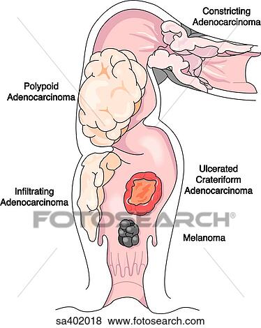 Stock Illustration - Sagittal section of the colon and rectum showing 5 different types of cancers and their typical locations.. Fotosearch