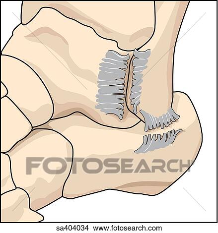 Strained ligaments. View Large Illustration Stock Illustration - Strained ligaments.. Fotosearch