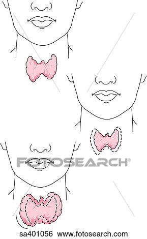 Three images of the chin and neck featuring thyroid glands of different sizes. View Large Illustration Stock Illustration - Three images of the chin and neck featuring thyroid glands of different sizes.. Fotosearch