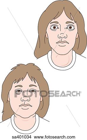 Two faces of an adult female exhibiting the symtoms of (bottom) hypothyroidism and (top) hyperthyroidism. View Large Illustration Stock Illustration - Two faces of an adult female exhibiting the symtoms of (bottom) hypothyroidism and (top) hyperthyroidism.. Fotosearch
