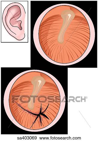 Two images of the tympanic membrane as viewed through an otoscope; (top right) normal, (bottom) ruptured. Orientation drawing (top left) of the ear. View Large Illustration Stock Illustration - Two images of the tympanic membrane as viewed through an otoscope; (top right) normal, (bottom) ruptured. Orientation drawing (top left) of the ear.. Fotosearch