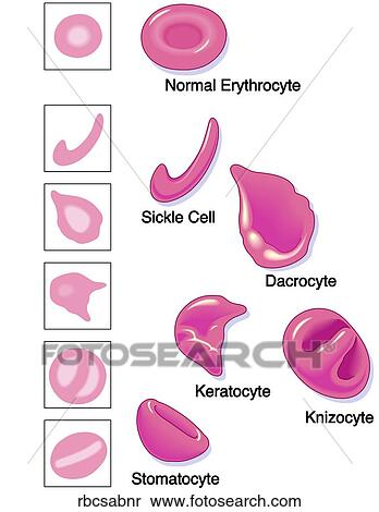 Abnormal Red Blood Cells View Large Illustration Stock Illustration - Abnormal Red Blood Cells. Fotosearch