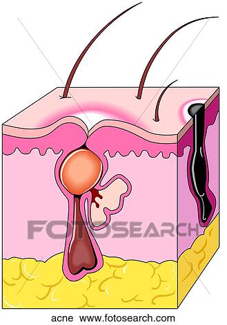 Clip Art - Acne. Fotosearch