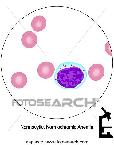 Clipart - Aplastic Anemia. Fotosearch
