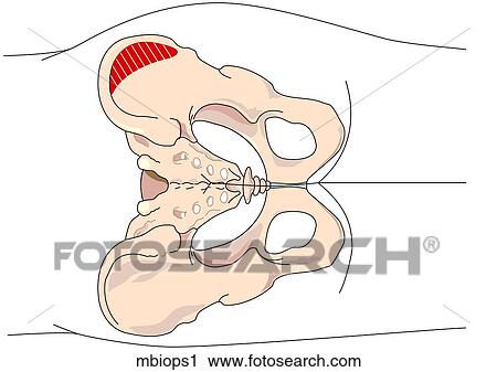 Bone Marrow Biopsy 1 View Large Illustration Clip Art - Bone Marrow Biopsy 1. Fotosearch