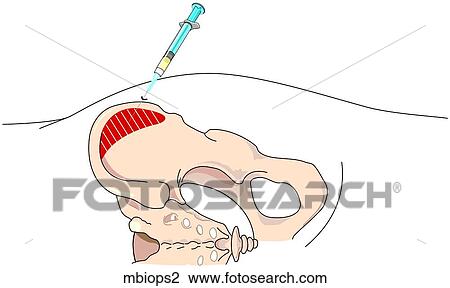 Bone Marrow Biopsy 2 View Large Illustration Drawing - Bone Marrow Biopsy 2. Fotosearch