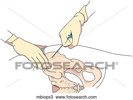Bone Marrow Biopsy 3 View Large Illustration Drawing - Bone Marrow Biopsy 3. Fotosearch