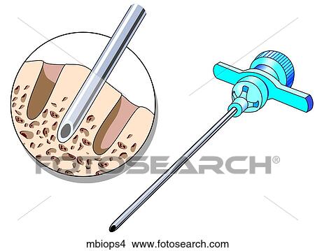Bone Marrow Biopsy 4 View Large Illustration Stock Illustration - Bone Marrow Biopsy 4. Fotosearch