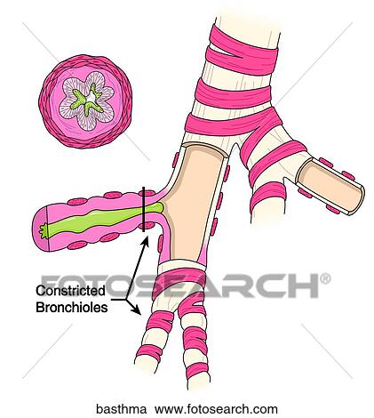 Bronchial Asthma View Large Illustration Clipart - Bronchial Asthma. Fotosearch