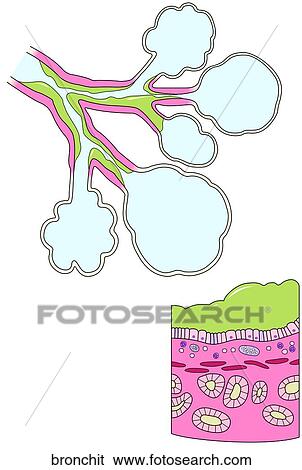 Stock Illustration - Chronic Bronchitis. Fotosearch