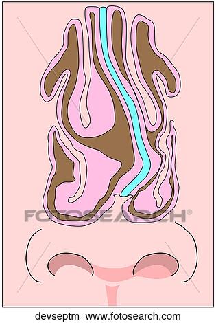 Stock Illustration - Deviated Nasal Septum. Fotosearch