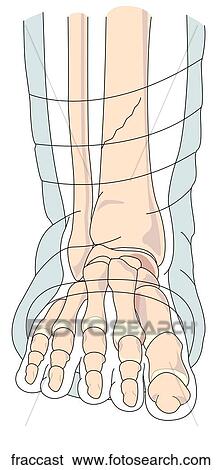 Fracture Repair with Cast View Large Illustration Stock Illustration - Fracture Repair with Cast. Fotosearch