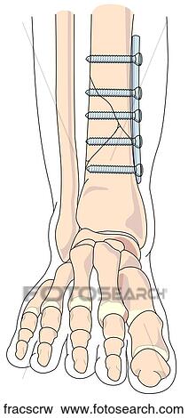Stock Illustration - Fracture Repair with Screws. Fotosearch