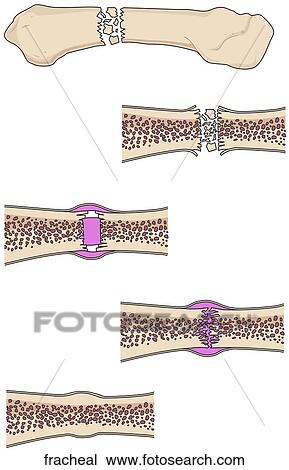 Drawing - How Fractures Heal. Fotosearch