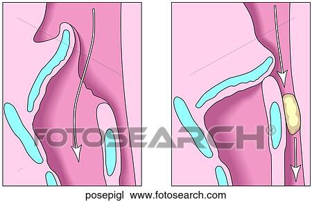 Drawing - Positions of Epiglottis. Fotosearch