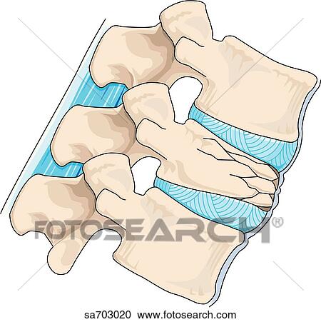 横の視野 の 脊柱 提示 圧縮 破砕 の A 椎骨 Without Arrows クリップアート 切り張り イラスト 絵画 集 Sa7030 Fotosearch