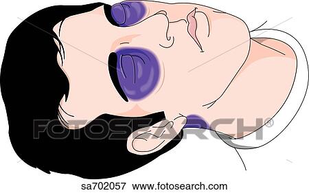 Anterolateral view of head and neck of adult male with multiple injuries to the head each of which are indicative of a skull fracture: Coon's eyes, Battle sign. View Large Illustration Stock Illustration - Anterolateral view of head and neck of adult male with multiple injuries to the head each of which are indicative of a skull fracture: Coon's eyes, Battle sign. . Fotosearch