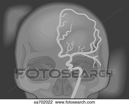cerebral arteriography. View Large Illustration Drawing - cerebral arteriography.. Fotosearch