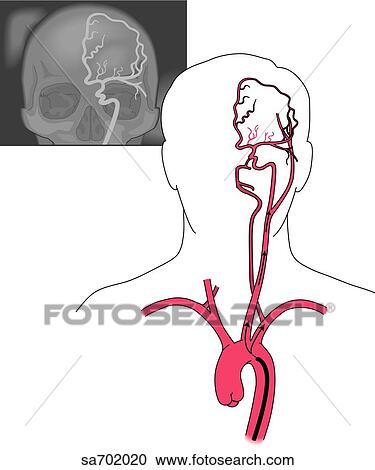 cerebral arteriography (upper left). Orientation figure (lower right) showing location and origination of pictured arteries. View Large Illustration Clipart - cerebral arteriography (upper left). Orientation figure (lower right) showing location and origination of pictured arteries.. Fotosearch