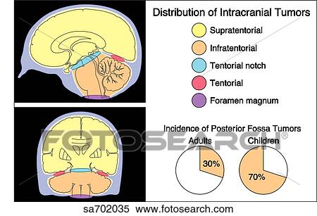 Stock Illustration - Chart showing location and distribution of intracranial tumors.. Fotosearch