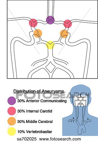 Close-up of circle of Willis showing the distribution of frequence of aneurysms for certain cerebral arteries. Orientation figure (lower right) shows anatomical location. View Large Illustration Stock Illustration - Close-up of circle of Willis showing the distribution of frequence of aneurysms for certain cerebral arteries. Orientation figure (lower right) shows anatomical location.. Fotosearch