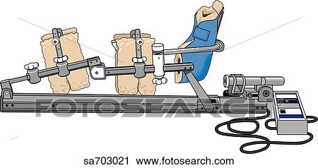 Continuous passive motion machine consisting of a mechanical splint to constantly move a joint. View Large Illustration Clip Art - Continuous passive motion machine consisting of a mechanical splint to constantly move a joint.. Fotosearch