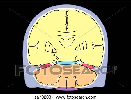 Stock Illustration - Coronal view of brain showing location and distribution of intracranial tumors.. Fotosearch