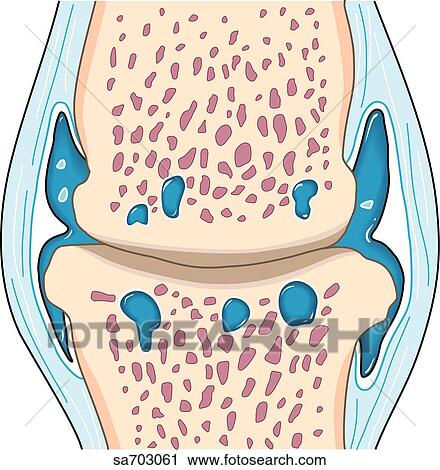 Clip Art - Cross-section of a synovial joint to show the progression of osteoarthritis: stage 4.. Fotosearch