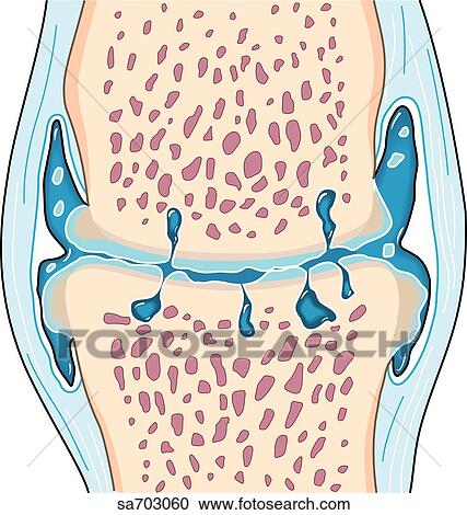 Cross-section of a synovial joint to show the progression of osteoarthritis: stage 3. View Large Illustration Clipart - Cross-section of a synovial joint to show the progression of osteoarthritis: stage 3.. Fotosearch