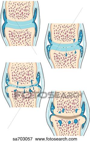 Cross-section of a synovial joint to show the progression of osteoarthritis (in four stages). View Large Illustration Stock Illustration - Cross-section of a synovial joint to show the progression of osteoarthritis (in four stages).. Fotosearch