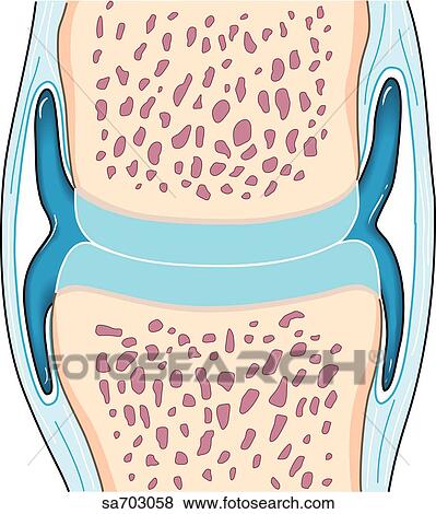 Stock Illustration - Cross-section of a synovial joint to show the progression of osteoarthritis: stage 1.. Fotosearch