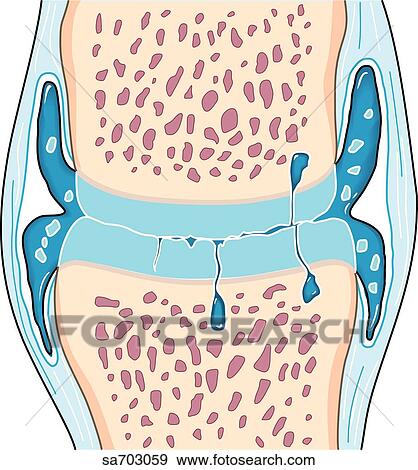 Cross-section of a synovial joint to show the progression of osteoarthritis: stage 2. View Large Illustration Stock Illustration - Cross-section of a synovial joint to show the progression of osteoarthritis: stage 2.. Fotosearch