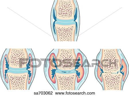 Drawing - Cross-section of small synovial joint showing progression of disease of rheumatoid arthritis in four steps.. Fotosearch