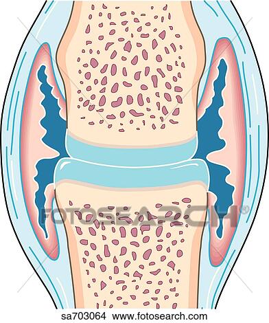 Cross-section of small synovial joint showing progression of disease of rheumatoid arthritis: step 2. View Large Illustration Stock Illustration - Cross-section of small synovial joint showing progression of disease of rheumatoid arthritis: step 2.. Fotosearch
