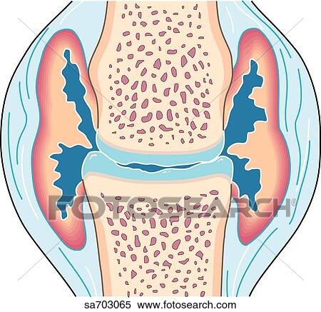 Stock Illustration - Cross-section of small synovial joint showing progression of disease of rheumatoid arthritis: step 3.. Fotosearch