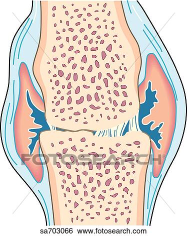 Cross-section of small synovial joint showing progression of disease of rheumatoid arthritis: step 4. View Large Illustration Stock Illustration - Cross-section of small synovial joint showing progression of disease of rheumatoid arthritis: step 4.. Fotosearch