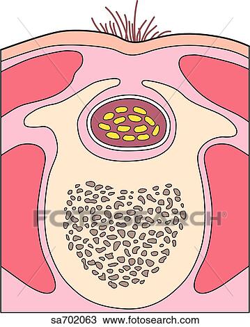 Cross-section of spinal area showing congenital defect in which part of vertebral column is absent. View Large Illustration Drawing - Cross-section of spinal area showing congenital defect in which part of vertebral column is absent.. Fotosearch