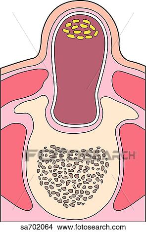 Cross-section of spinal area showing congenital defect in a more extreme case where spinal cord protrudes beyond vertebral absence. View Large Illustration Stock Illustration - Cross-section of spinal area showing congenital defect in a more extreme case where spinal cord protrudes beyond vertebral absence.. Fotosearch