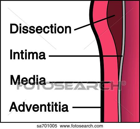 Cross-section of wall shows pathological process of splitting of media layer. View Large Illustration Stock Illustration - Cross-section of wall shows pathological process of splitting of media layer.. Fotosearch
