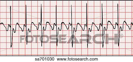 EKG wave indicative of an atrial flutter. View Large Illustration Clipart - EKG wave indicative of an atrial flutter.. Fotosearch