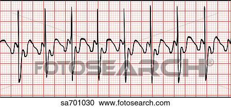 Stock Illustrations of EKG wave indicative of an atrial flutter ...