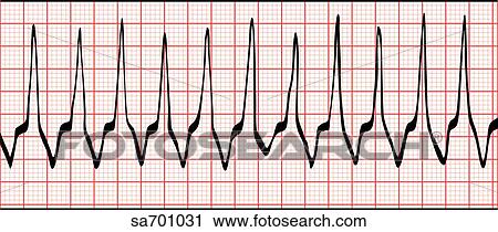 Clip Art - EKG wave indicative of supraventricular tachycardia.. Fotosearch